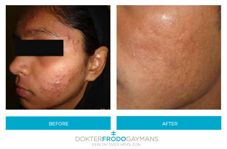 Close up of a woman before and after RF microneedling