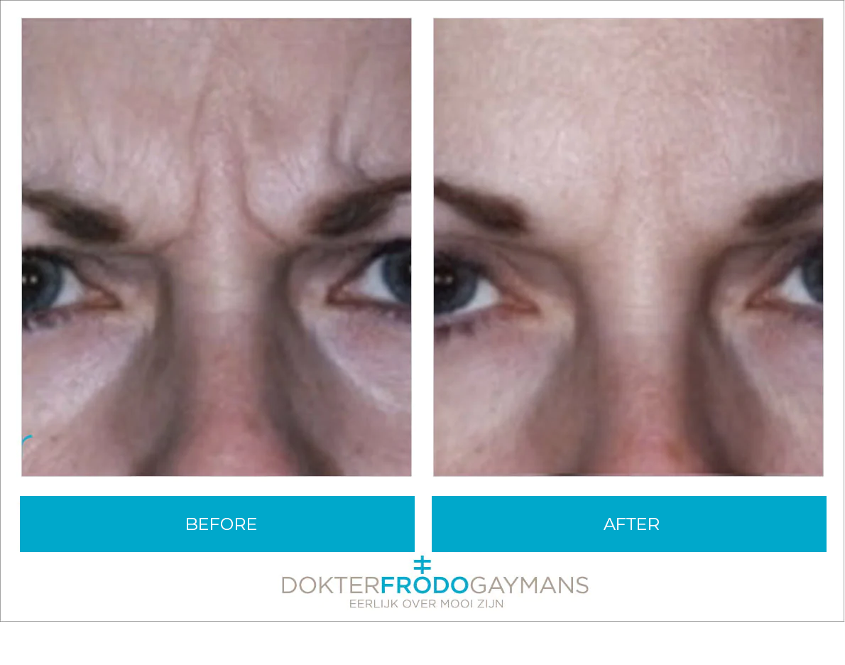 Botox frown lines before and after treatment