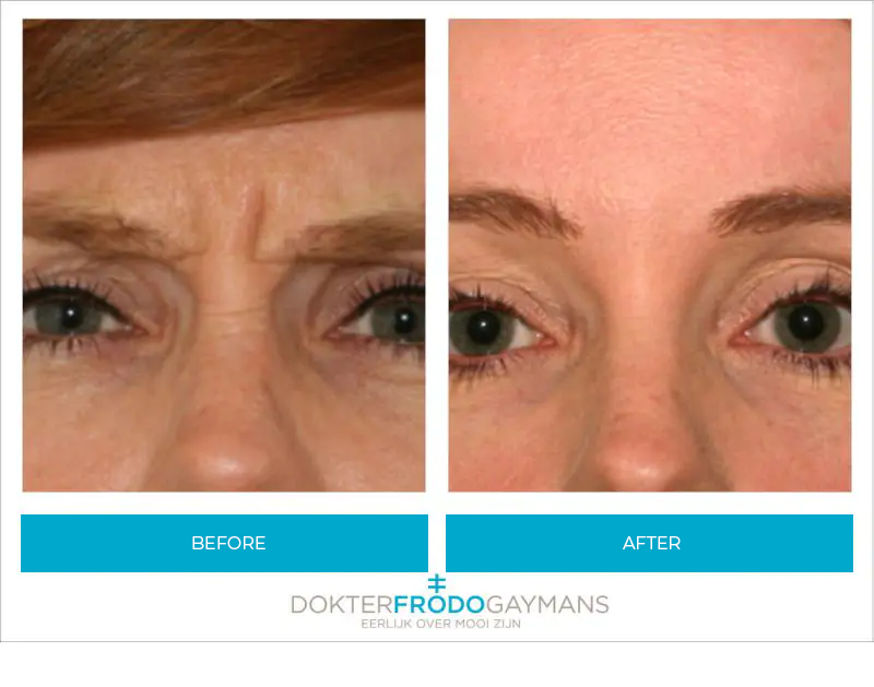 Before and after close up of a woman who underwent a Botox frown lines treatment